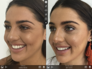 Anti Wrinkle and Cheeks