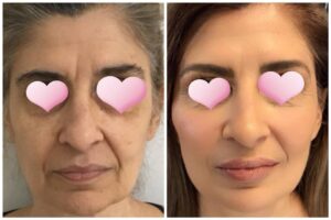 Full Face Rejuvenation