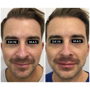 Anti Wrinkle and Lips