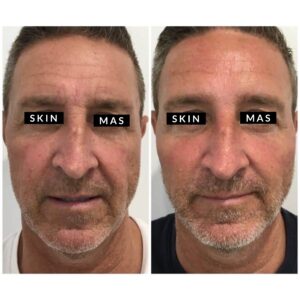 Anti Wrinkle