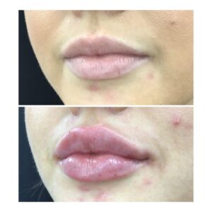 Juicy Lips Side