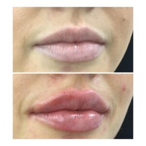lips 12
