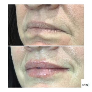 Lip Rejuvenation