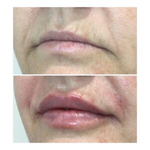 Lip Rejuvenation Side