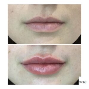 lips 4