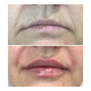 lips 5