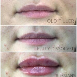 Dissolving old filler and creating new Russians