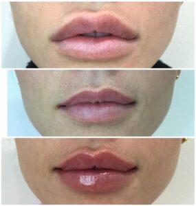 Dissolving old filler and creating