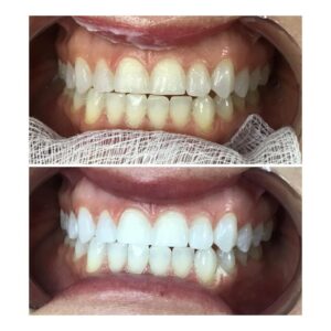 Teeth Whitening